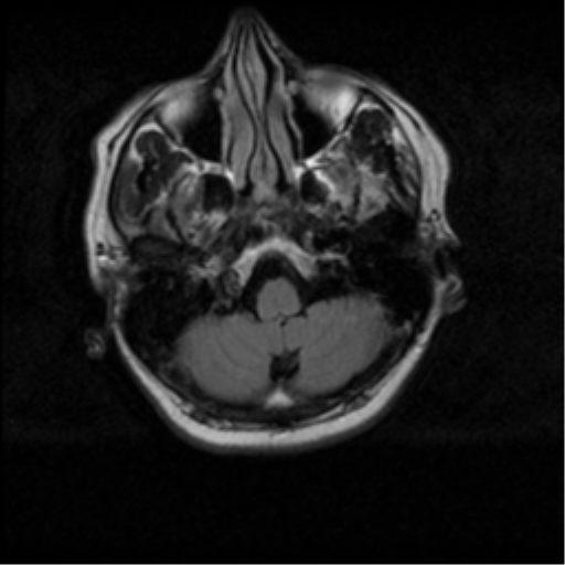 File:Acoustic schwannoma (Radiopaedia 33045-34060 Axial FLAIR 3).png