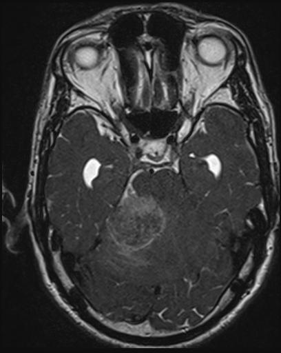 Acoustic schwannoma - probable (Radiopaedia 20386-20292 Axial T1 51).jpg