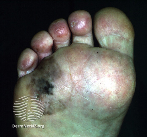 File:Acral lentignous melanoma (DermNet NZ lesions-melanoma-alm2).jpg
