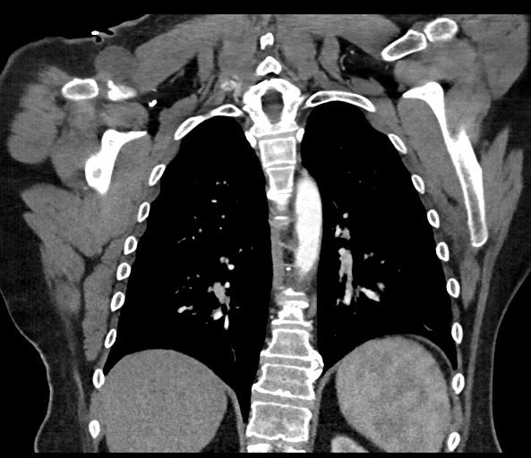 File:Acromioclavicular joint cyst (Radiopaedia 58455-65610 Coronal C+ arterial phase 101).jpg