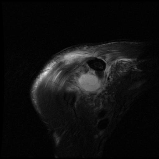 File:Acromioclavicular joint dislocation (Radiopaedia 14218-14076 Coronal PD fat sat 6).jpg