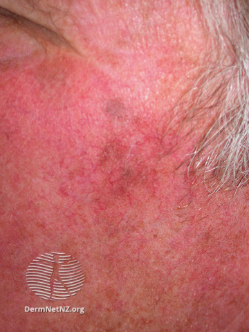 Actinic Keratoses affecting the face (DermNet NZ lesions-ak-face-272).jpg
