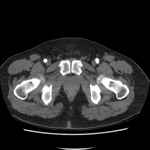 File:Active colonic bleed on CT (Radiopaedia 49765-55025 Axial C+ arterial phase 84).jpg
