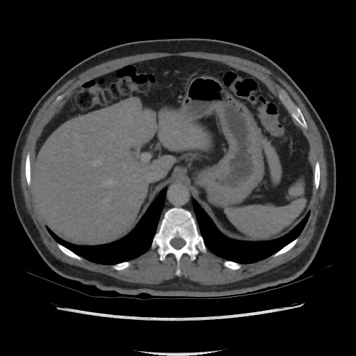 File:Active colonic bleed on CT (Radiopaedia 49765-55025 Axial C+ delayed 19).jpg