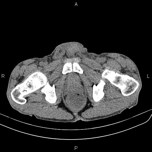 Active crohn disease (Radiopaedia 87133-103397 Axial non-contrast 103).jpg