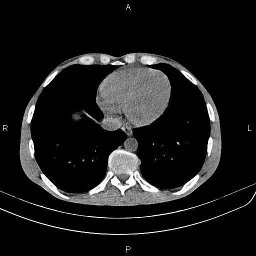 File:Active crohn disease (Radiopaedia 87133-103397 Axial non-contrast 5).jpg