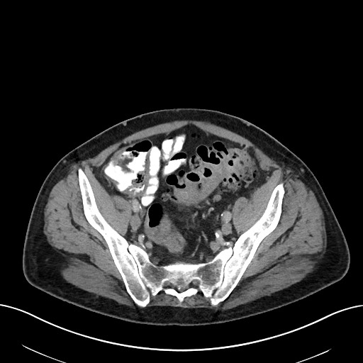 File:Active lower gastrointestinal bleeding - diverticular (Radiopaedia 61203-69106 Axial C+ portal venous phase 100).jpg