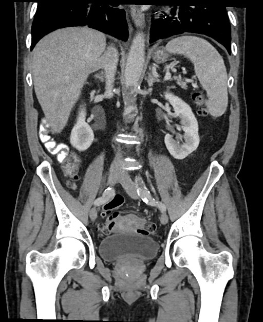 Active lower gastrointestinal bleeding - diverticular (Radiopaedia 61203-69106 Coronal C+ portal venous phase 78).jpg