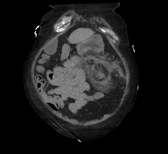 Active renal extravasation with large subcapsular and retroperitoneal hemorrhage (Radiopaedia 60975-68796 Coronal C+ arterial phase 36).jpg
