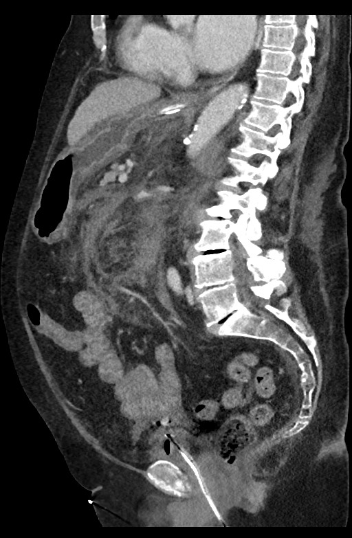 Active renal extravasation with large subcapsular and retroperitoneal hemorrhage (Radiopaedia 60975-68796 Sagittal C+ portal venous phase 114).jpg