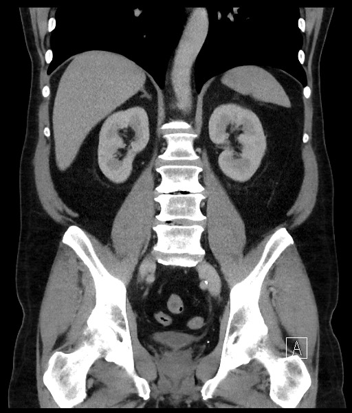 Acute-on-chronic pancreatitis (Radiopaedia 67286-76656 Coronal C+ portal venous phase 49).jpg