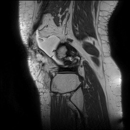 File:Acute-on-chronic transient lateral patellar dislocation with trochlear dysplasia (Radiopaedia 84099-99349 Sagittal PD 131).jpg