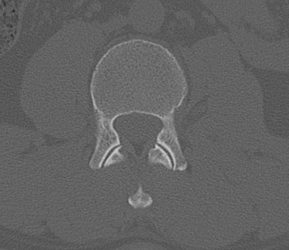 File:Acute L1 burst compression fracture (Radiopaedia 34430-35755 Axial bone window 44).png