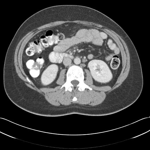 Acute appendicitis (Radiopaedia 30297-30934 Axial C+ portal venous phase 38).jpg