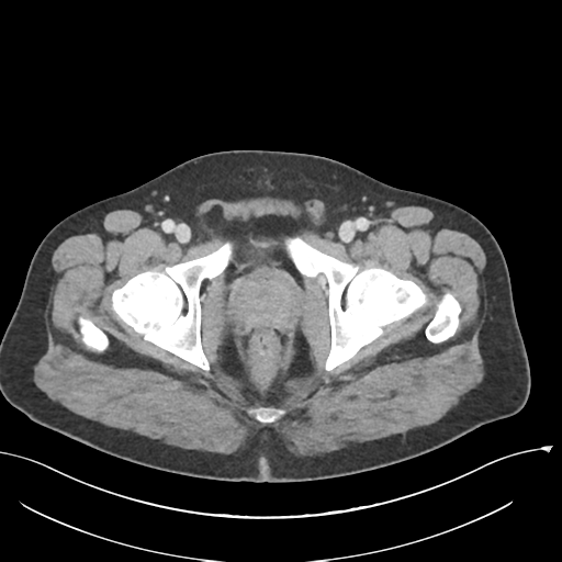 Acute appendicitis (Radiopaedia 36611-38177 Axial C+ portal venous phase 89).png