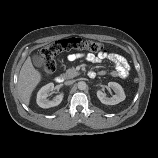 Acute appendicitis (Radiopaedia 48511-53463 Axial C+ portal venous phase 38).jpg
