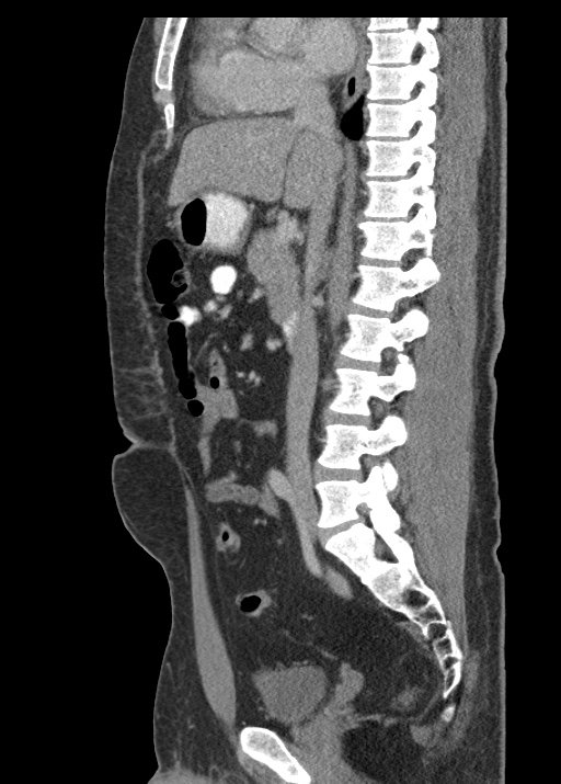 Acute appendicitis (Radiopaedia 48511-53463 Sagittal C+ portal venous phase 67).jpg