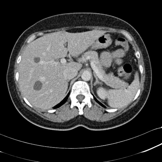 File:Acute appendicitis (Radiopaedia 48792-53822 Axial C+ portal venous phase 27).jpg