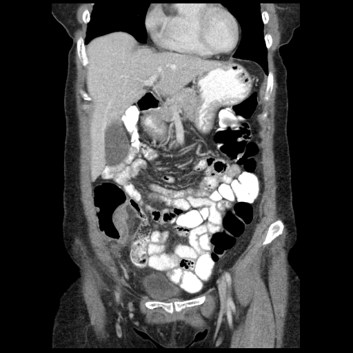Acute appendicitis (Radiopaedia 52672-58589 Coronal C+ portal venous phase 20).jpg