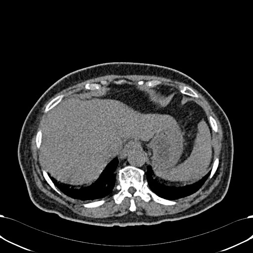 Acute appendicitis (Radiopaedia 58627-65818 Axial non-contrast 14).jpg