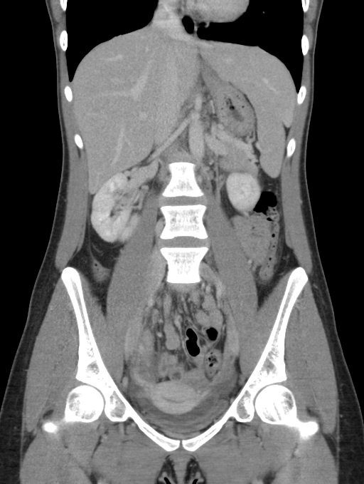 Acute appendicitis (Radiopaedia 62608-70901 Coronal C+ portal venous phase 24).jpg