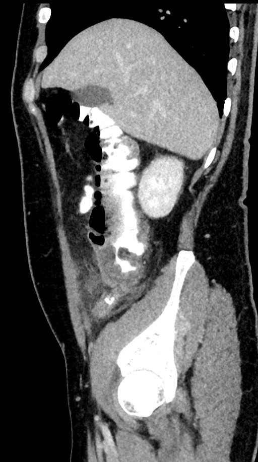 Acute appendicitis (Radiopaedia 77016-88960 Sagittal C+ portal venous phase 87).jpg