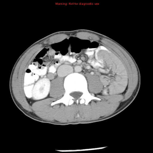 Acute appendicitis (Radiopaedia 8195-9045 Axial C+ portal venous phase 38).jpg