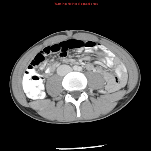 Acute appendicitis (Radiopaedia 8195-9045 Axial C+ portal venous phase 42).jpg