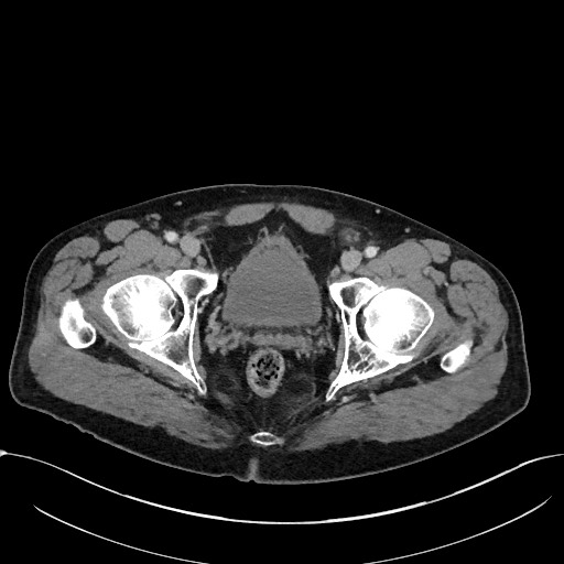 Acute appendicitis - large appendicoliths (Radiopaedia 61805-69820 Axial C+ portal venous phase 124).jpg