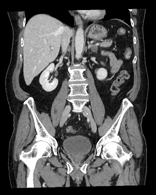 Acute appendicitis - large appendicoliths (Radiopaedia 61805-69820 Coronal C+ portal venous phase 75).jpg