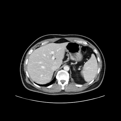 Acute appendicitis and COVID 19 pneumonia (Radiopaedia 76604-88380 Axial C+ portal venous phase 18).jpg