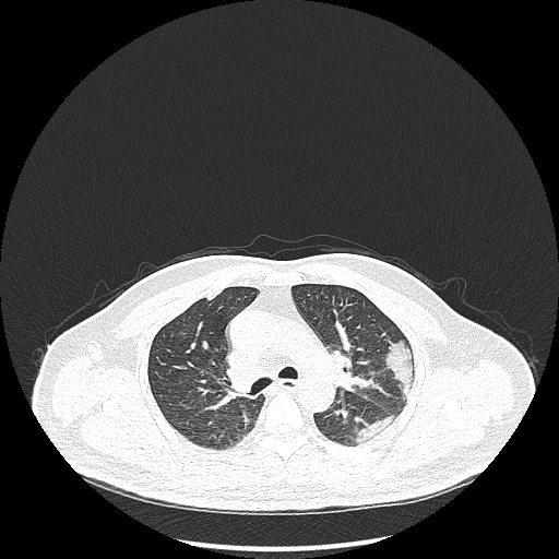 Acute appendicitis and COVID 19 pneumonia (Radiopaedia 76604-88380 Axial lung window 21).jpg