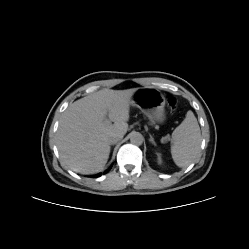 Acute appendicitis and COVID 19 pneumonia (Radiopaedia 76604-88380 Axial non-contrast 55).jpg