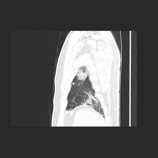 File:Acute appendicitis and COVID 19 pneumonia (Radiopaedia 76604-88380 Sagittal lung window 85).jpg