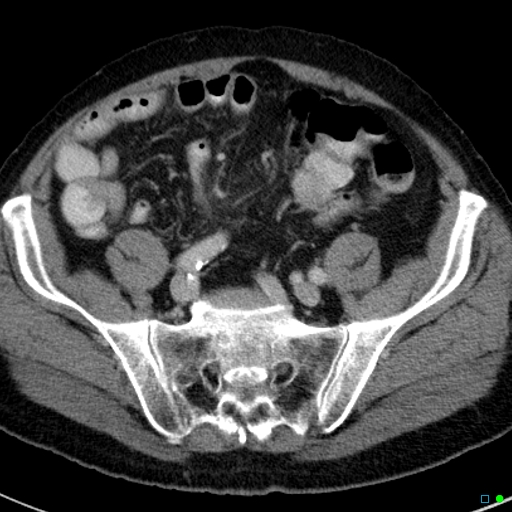 File:Acute appendicitis arising from a malrotated cecum (Radiopaedia 19970-19997 Axial C+ portal venous phase 33).jpg