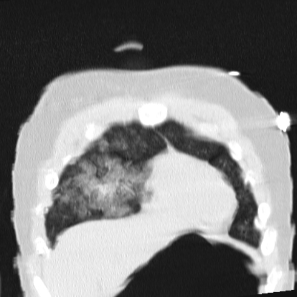 Acute aspiration pneumonitis (Radiopaedia 33605-34703 Coronal lung window 19).jpg