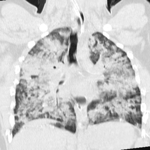 Acute aspiration pneumonitis (Radiopaedia 33605-34703 Coronal lung window 46).jpg