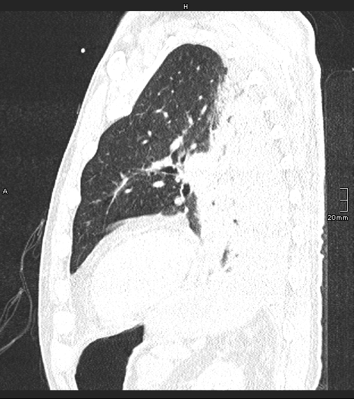 Acute aspiration pneumonitis (Radiopaedia 55642-62166 Sagittal lung window 42).jpg
