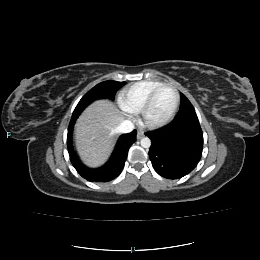 Acute bilateral pyelonephritis (Radiopaedia 37146-38881 Axial C+ portal venous phase 3).jpg