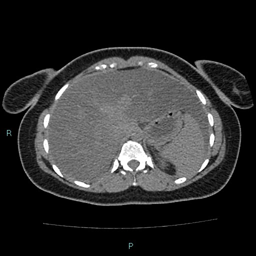Acute bilateral pyelonephritis (Radiopaedia 37146-38881 Axial non-contrast 22).jpg