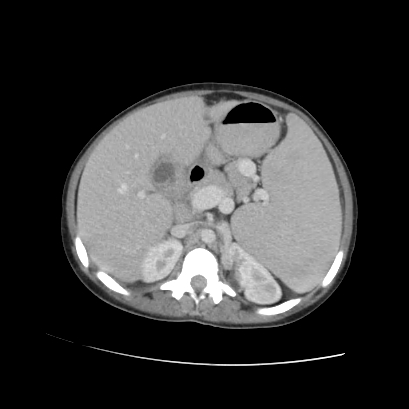 File:Acute calculous cholecystitis in patient with osteopetrosis (Radiopaedia 77871-90159 Axial C+ portal venous phase 33).jpg