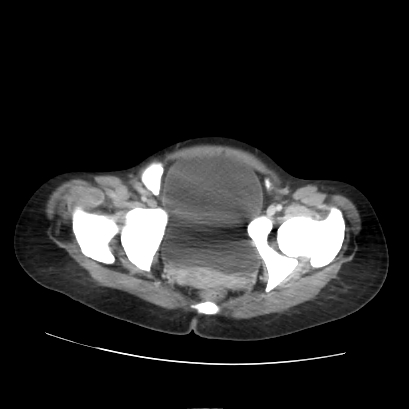 Acute calculous cholecystitis in patient with osteopetrosis (Radiopaedia 77871-90159 Axial C+ portal venous phase 74).jpg