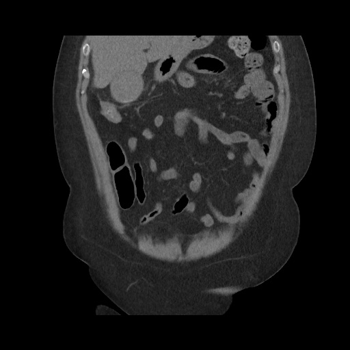 Acute cholecystitis with tensile fundus sign (Radiopaedia 71394-81723 Coronal non-contrast 44).jpg