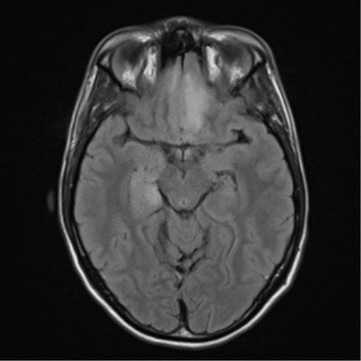 File:Acute disseminated encephalomyelitis (ADEM) (Radiopaedia 65319-74349 Axial FLAIR 13).png