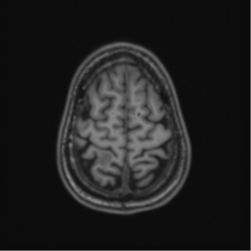 Acute disseminated encephalomyelitis (ADEM) (Radiopaedia 65319-74349 Axial T1 59).png
