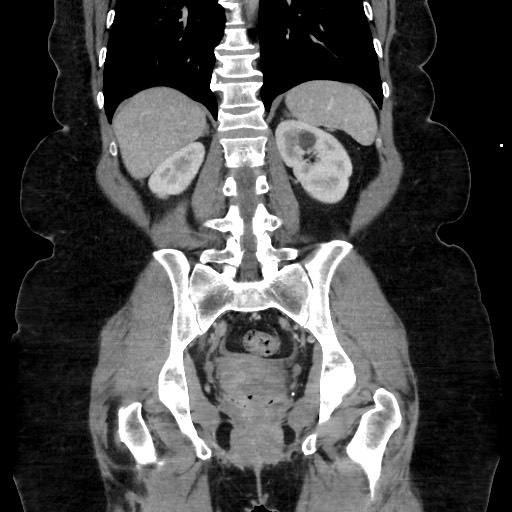 Acute diverticulitis - transverse colon (Radiopaedia 87063-103327 Coronal C+ portal venous phase 109).jpg