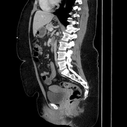 Acute diverticulitis - transverse colon (Radiopaedia 87063-103327 Sagittal C+ portal venous phase 128).jpg