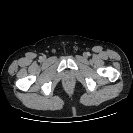 Acute diverticulitis with localized perforation (Radiopaedia 41296-44113 Axial C+ portal venous phase 94).jpg