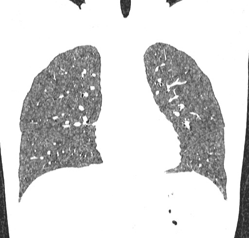 Acute hypersensitivity pneumonitis (Radiopaedia 85293-100870 Coronal lung window 48).jpg