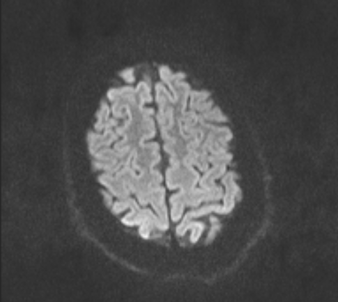 Acute ischemic stroke - posterior circulation territory (Radiopaedia 77670-89880 Axial DWI 66).jpg